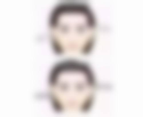 一、做双眼皮抽脂的适合情况