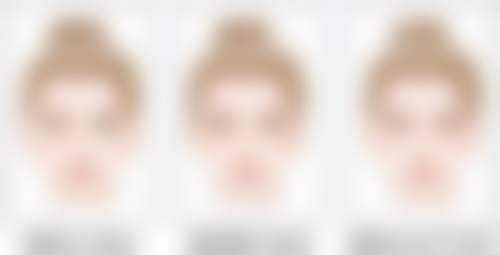 二、做双眼皮抽脂需要谨慎评估的情况