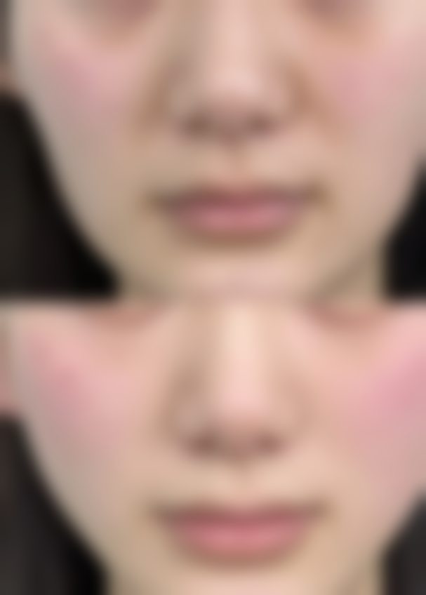 四、如何降低脸上打除皱针的风险