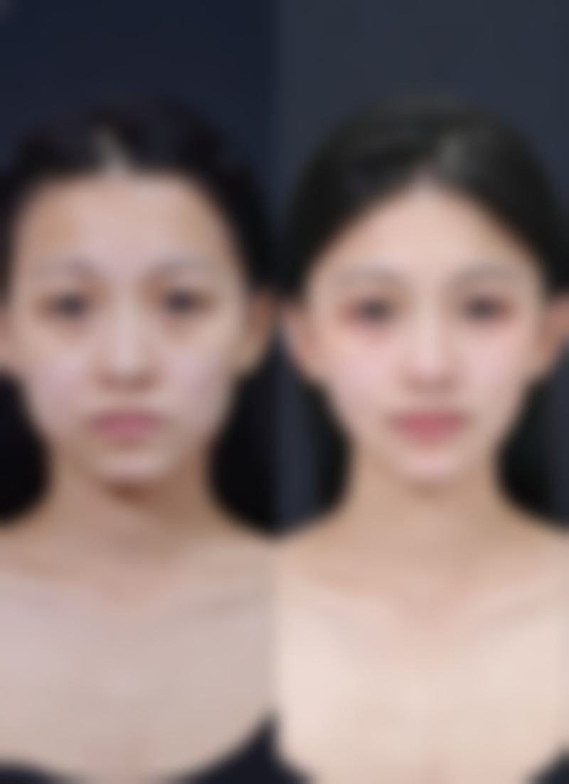 {脸上打除皱针有什么后遗症、副作用？常见反应及应对建议一文读懂！ 