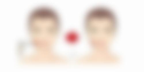 {凹陷疤痕色素沉淀怎么消除？分享小妙招，助你实现平整肤质、均匀肤色