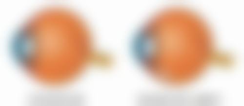 三、隆鼻膨体和假体的感染风险差异