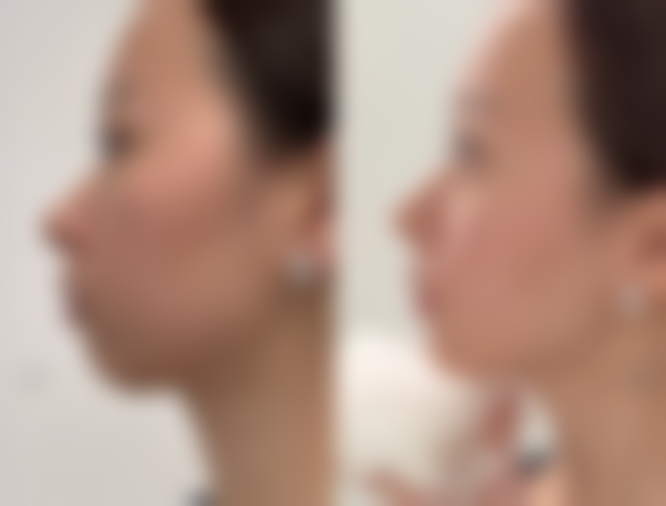 五、隆鼻膨体和假体的适用人群分析