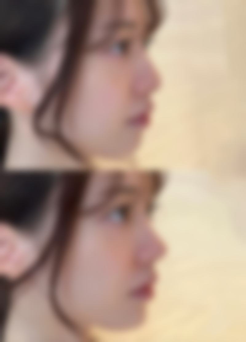 二、隆鼻膨体和假体在美观度上的表现