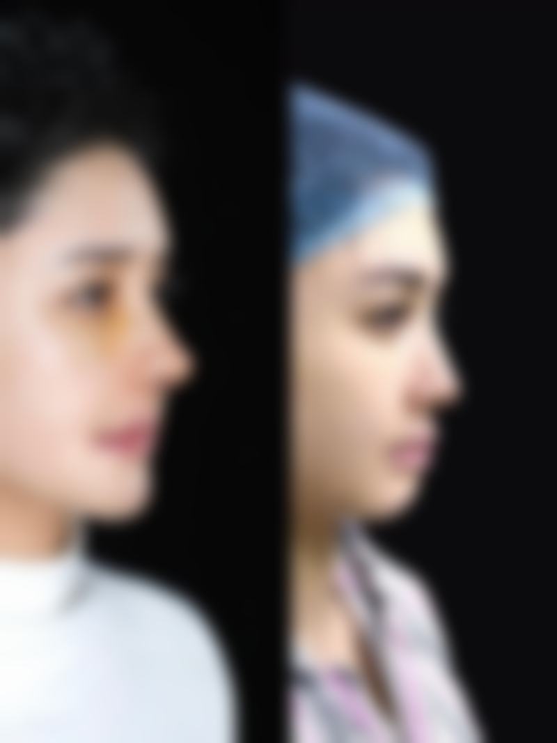 五、凹陷疤痕色素沉淀消除的注意事项