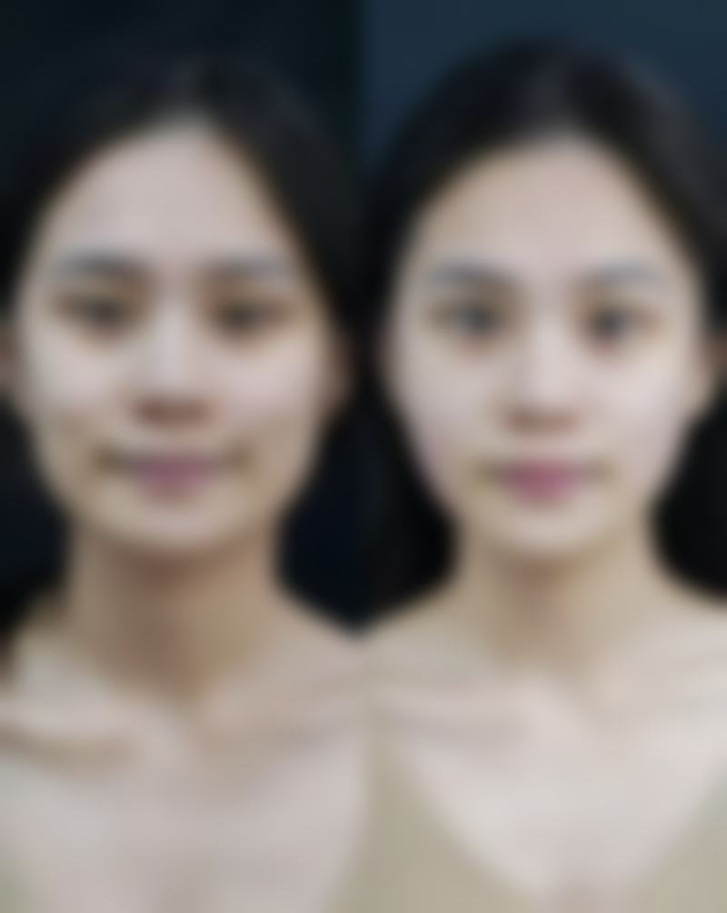 五、40岁女性隆胸的术前准备