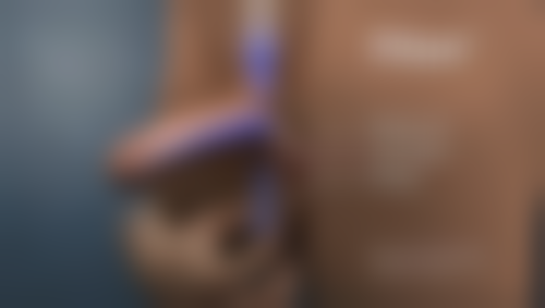 {做眼袋要多久才能恢复？揭秘不同术式恢复周期及加速恢复的秘诀 