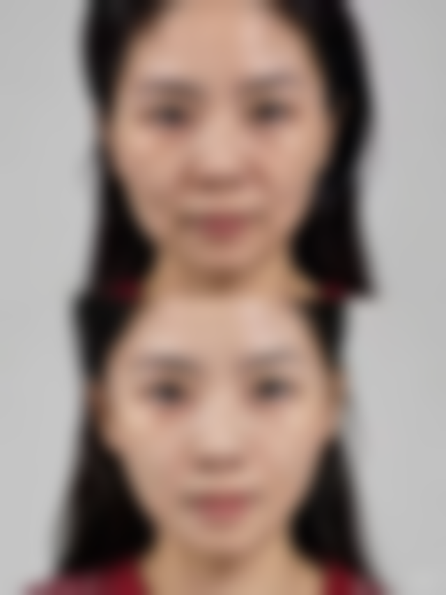 一、隆鼻会有什么后遗症之常见后遗症类型