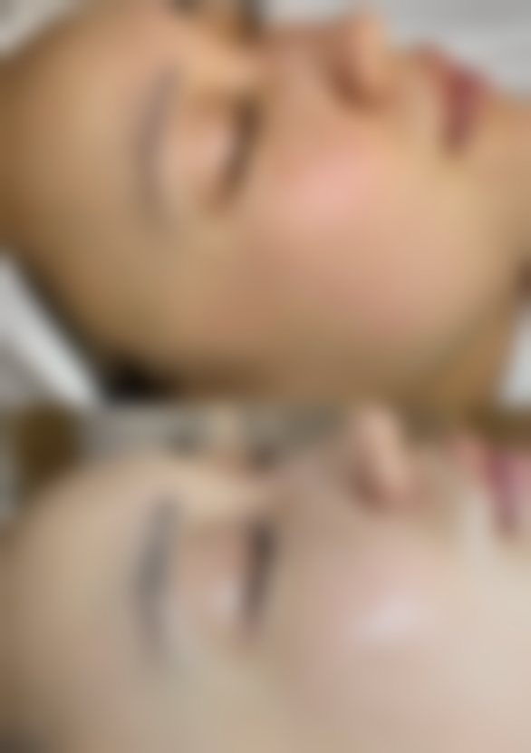 二、不同术式的修复周期