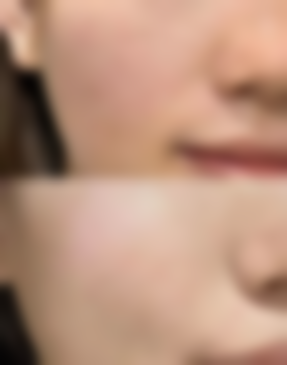 二、外双眼皮特点解析