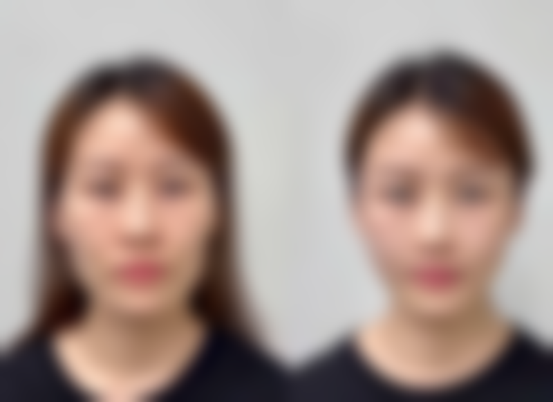 二、做自体隆鼻手术疼吗？手术过程的解析