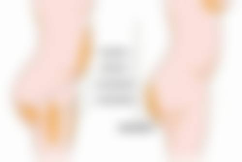 二、哭出来的双眼皮消失情况分析