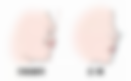 四、抽脂后促进消肿和瘦身成效显现的方法