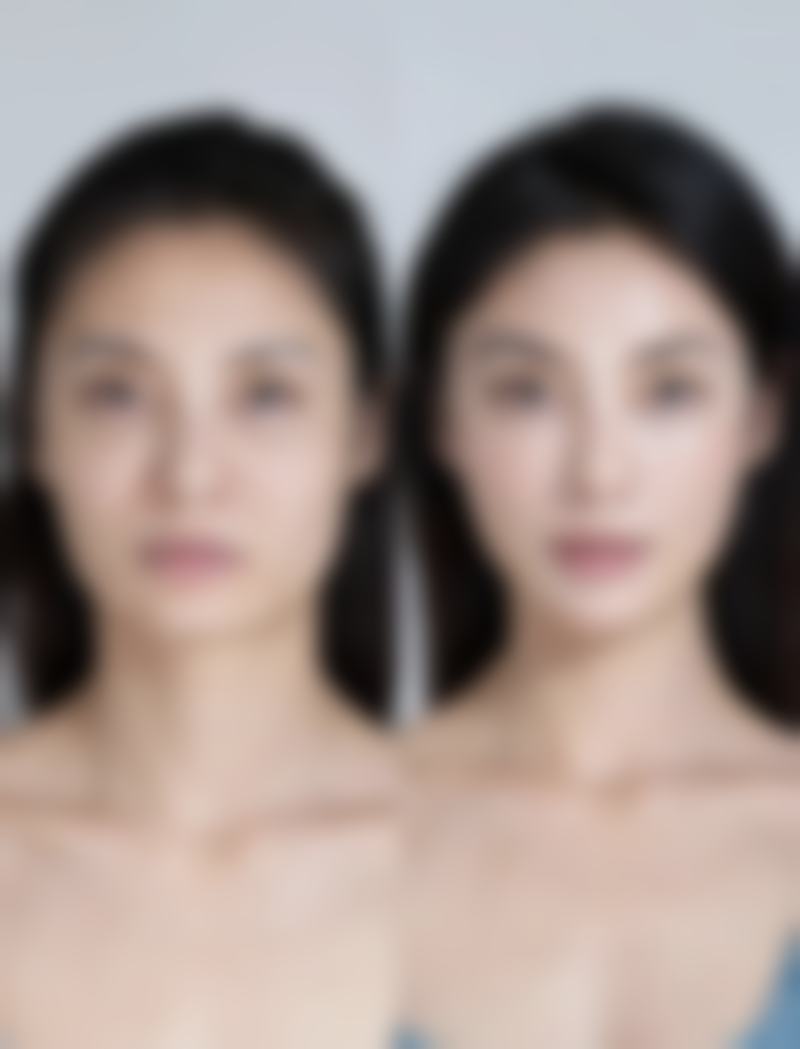 二、怎么能治疤痕增生之手术治疗