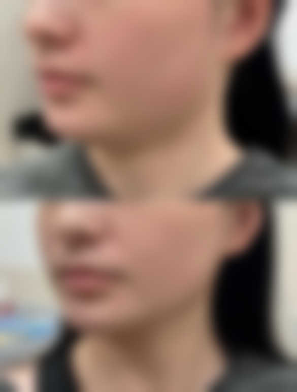 无痕去眼袋的成效怎么样？