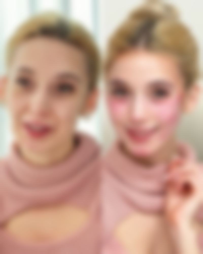 五、抽脂后肿胀异常的处理