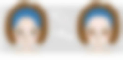 五、怎么消眼袋成效好之联合治疗