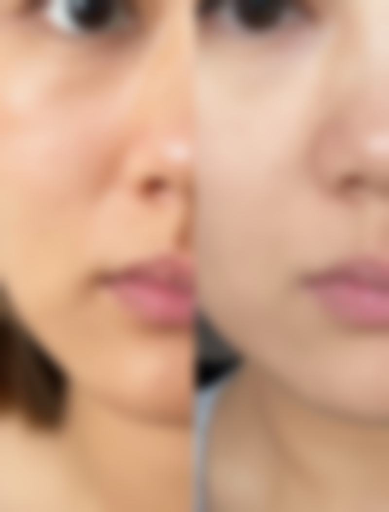 二、不同原因导致的做完眼袋半个月还红痒的对应处理方法