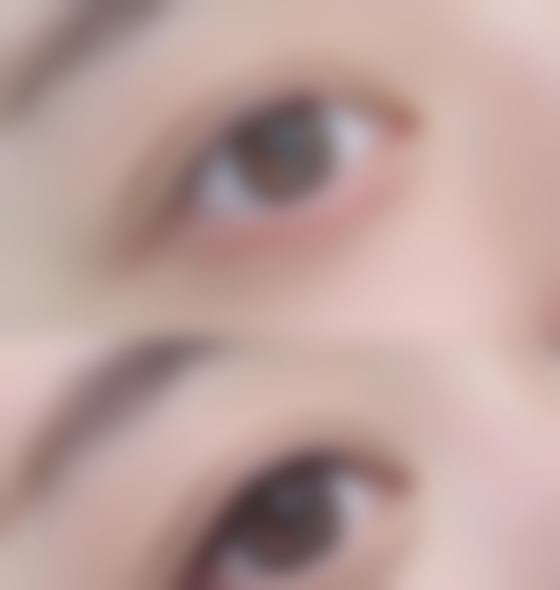 二、贫血做双眼皮有危险吗？危险到底在哪