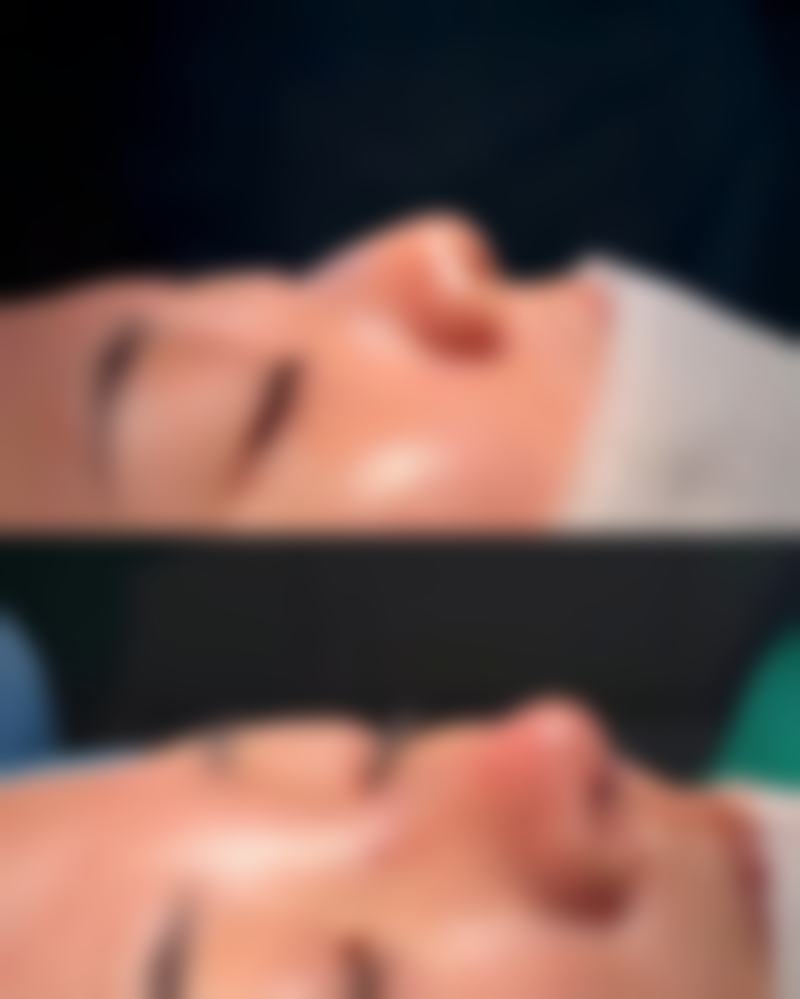 二、隆鼻多久可以吃酱油