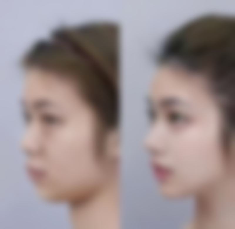 一、隆鼻多久可以吃辣椒