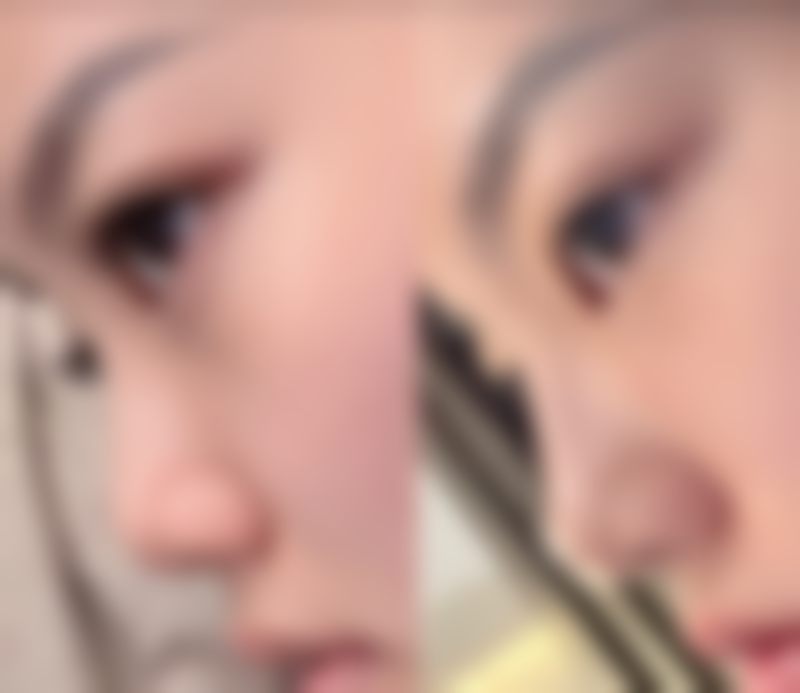 三、贫血做双眼皮有危险吗？女性贫血患者的特殊情况