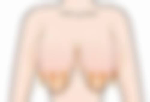 三、鼻唇沟疤痕修复之压力治疗