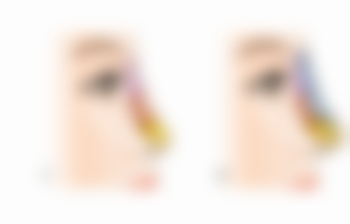 二、发际线种植罕见但重度的并发症