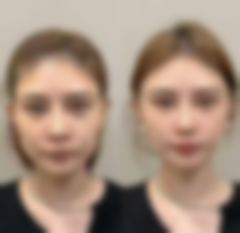 四、总结：色素沉着疤痕会消失吗？