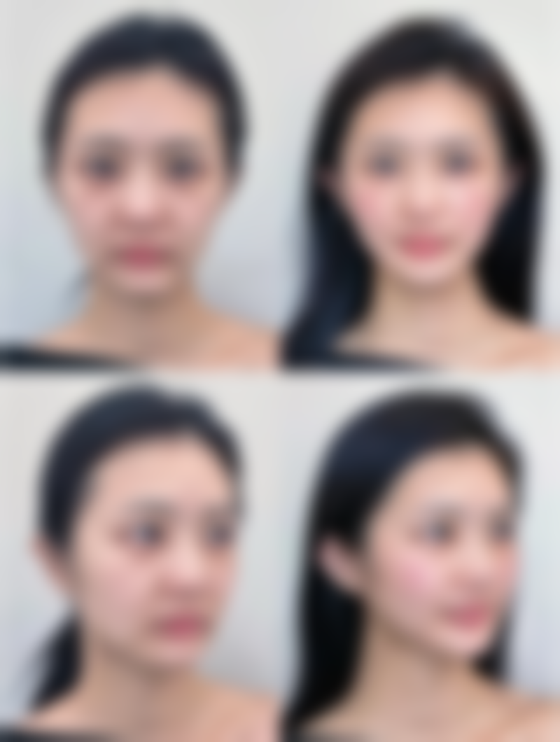 六、发际线种植的费用