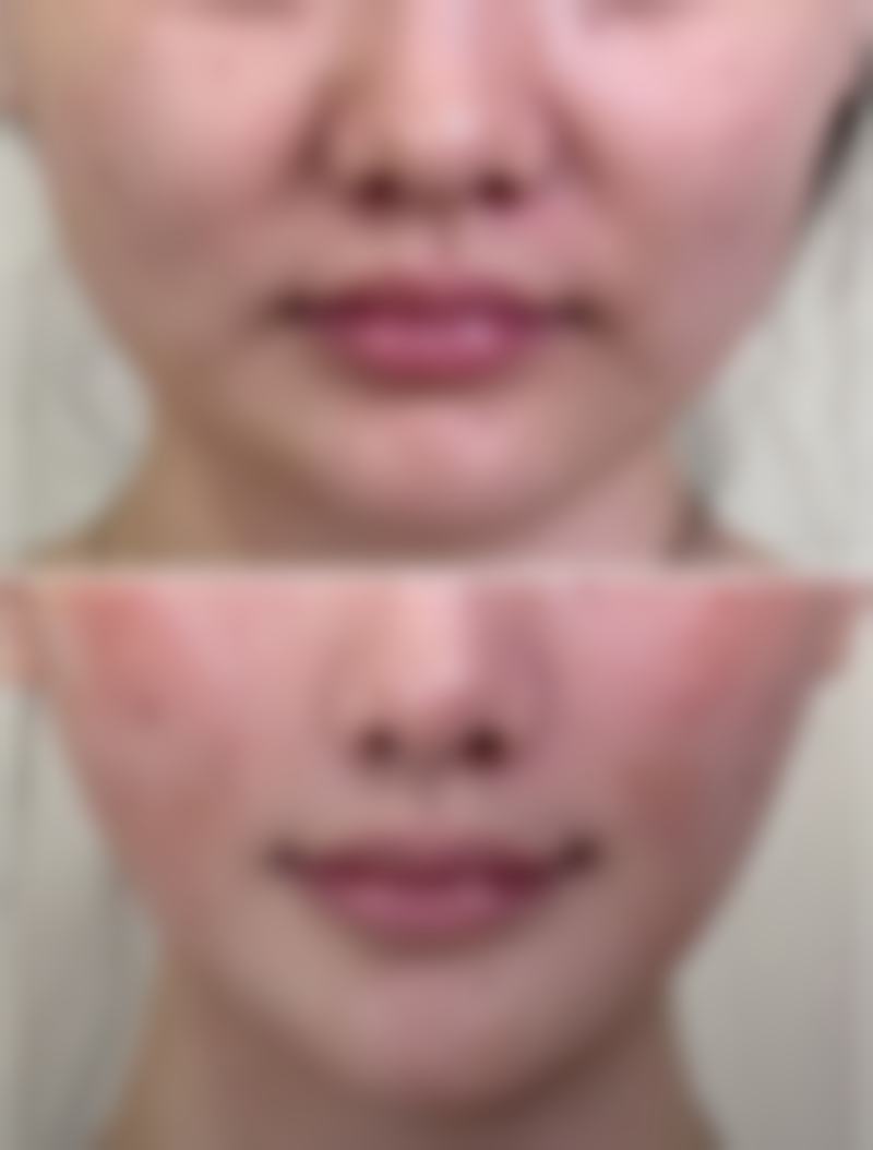 发际线种植有风险吗？