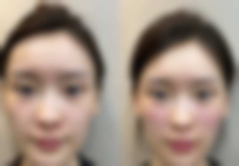 五、发际线种植的成效及维持时间