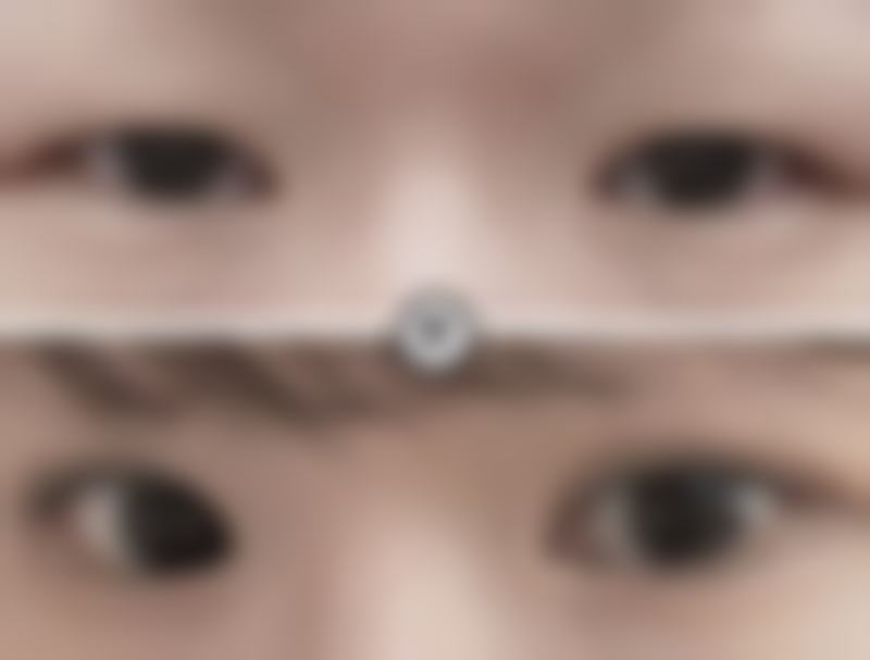 二、影响色素沉着疤痕消失的因素