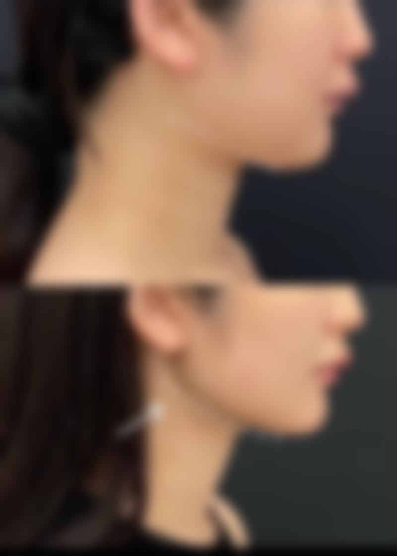 三、降低发际线种植风险的方法