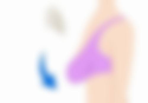 一、认识疤痕疙瘩