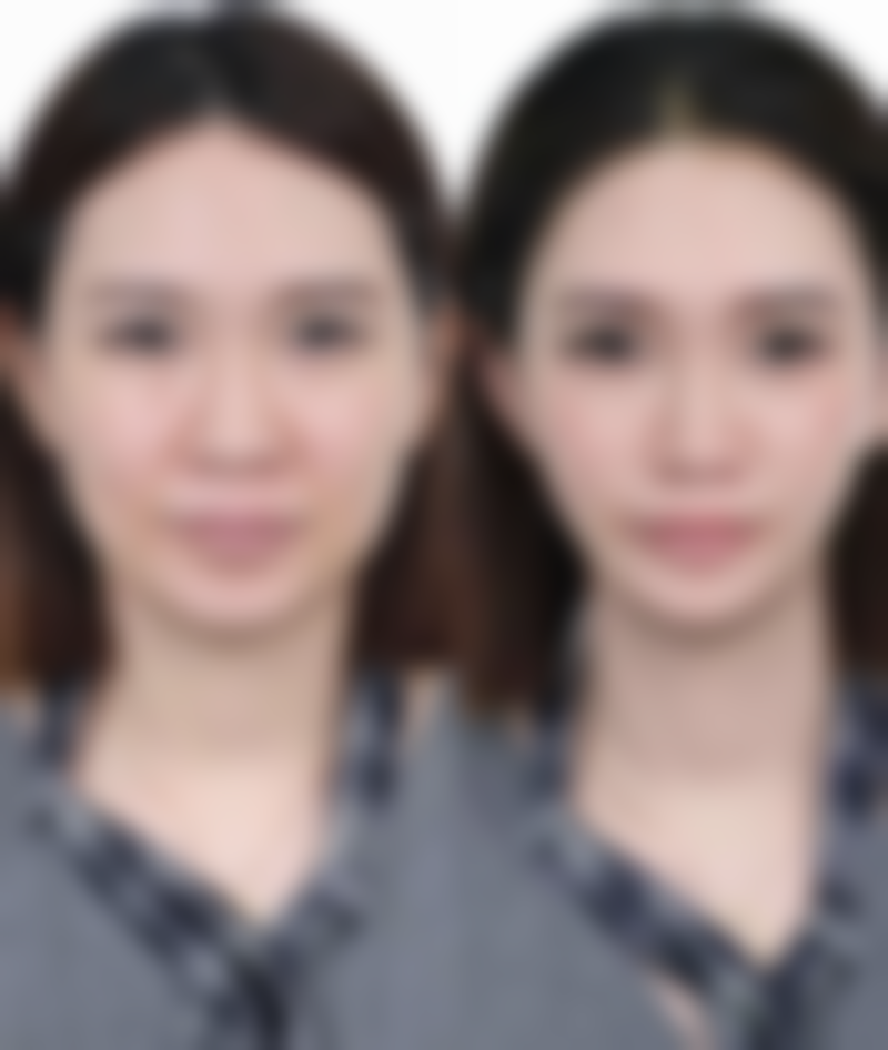 一、什么治疗眼袋成效好快之手术治疗