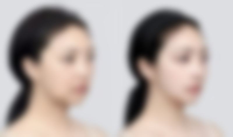 {疤痕疙瘩怎么治疗最好呢？正规医院多种疗法结合助你有效应对疤痕疙瘩