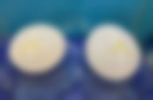 {双眼皮拆线之后眼角有小疙瘩能恢复好吗？多种方法助你了解恢复可能及应对之策 