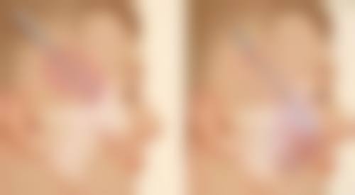 四、如何减少不缝合疤痕的形成