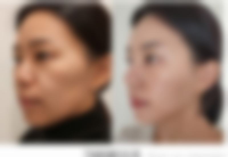 {如何去除老年人眼袋？手术、激光等方法揭秘，助老人告别眼袋烦恼