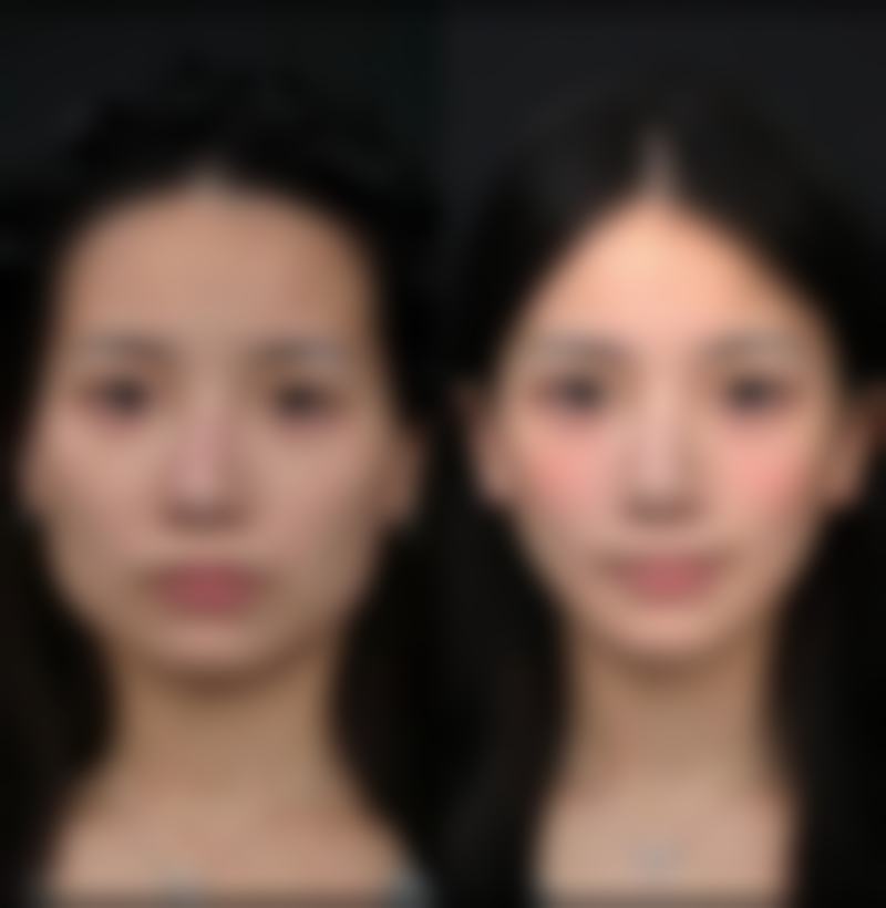 二、不缝合疤痕的常见类型