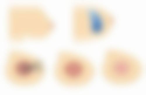 一、全切双眼皮手术的魅力