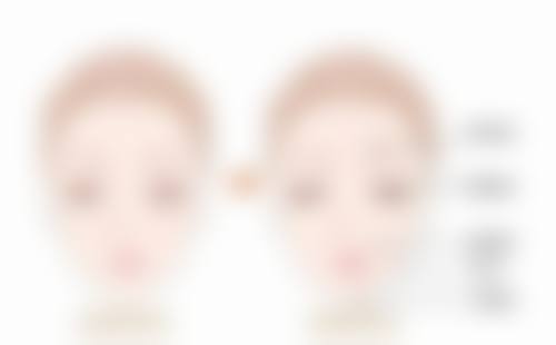 二、感染因素导致大腿抽脂后痒及修复时间