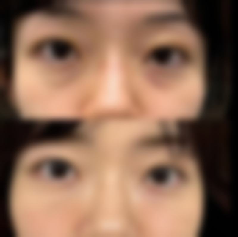 三、50单位和100单位瘦脸针的区别