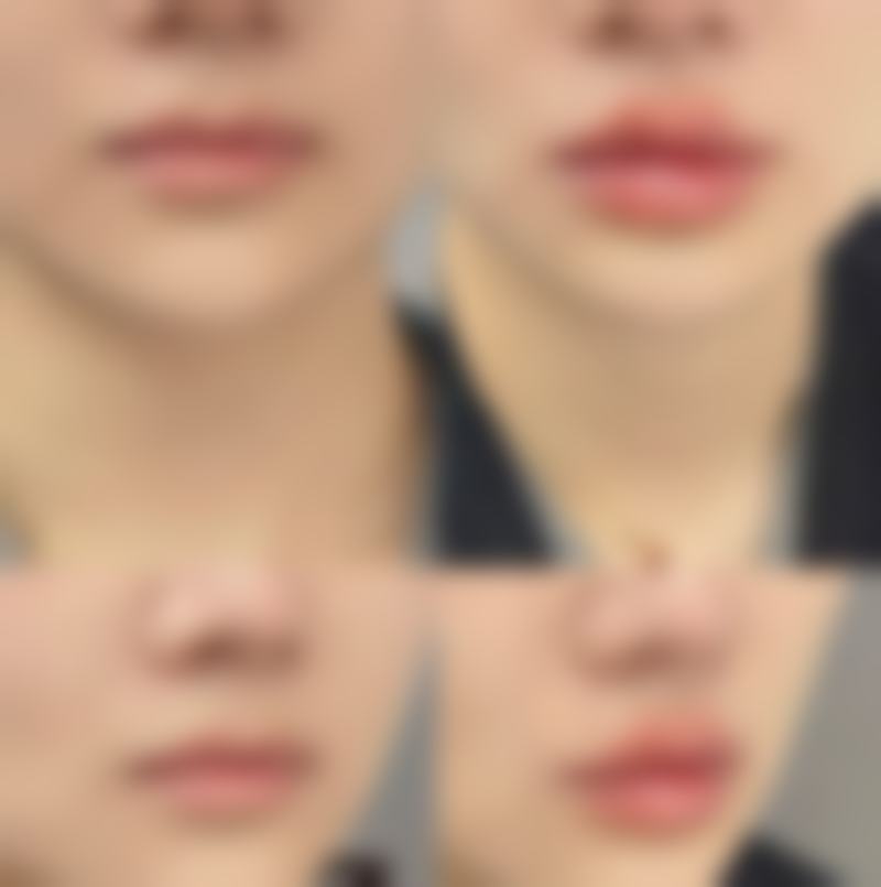 五、除皱针面部提升的优缺点