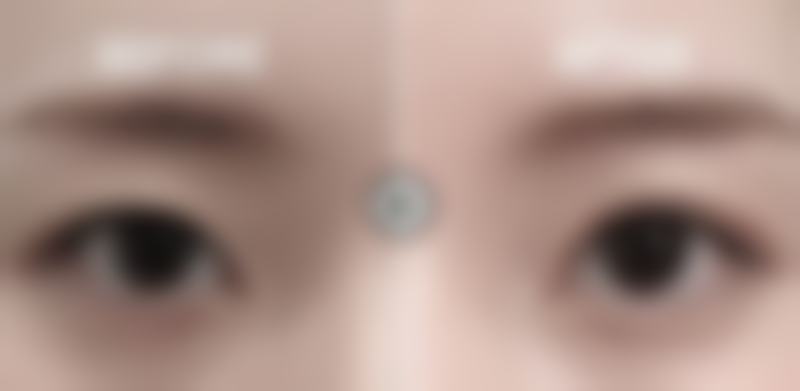 大腿抽脂后痒多久能修复呢？