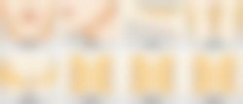 三、纳米双眼皮和割双眼皮的成效对比