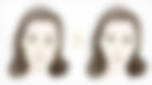 四、纳米双眼皮和割双眼皮的修复情况