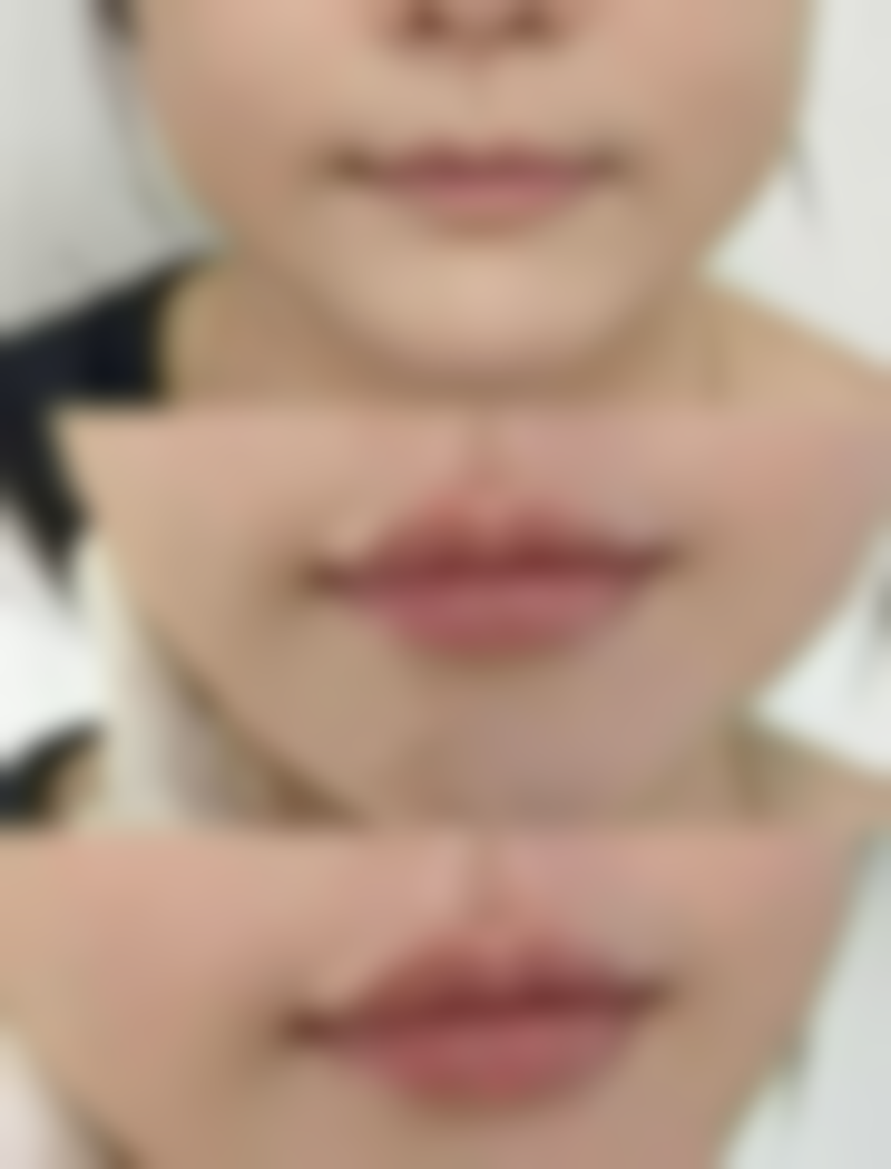 四、瘦脸针成效消退后的处理方法