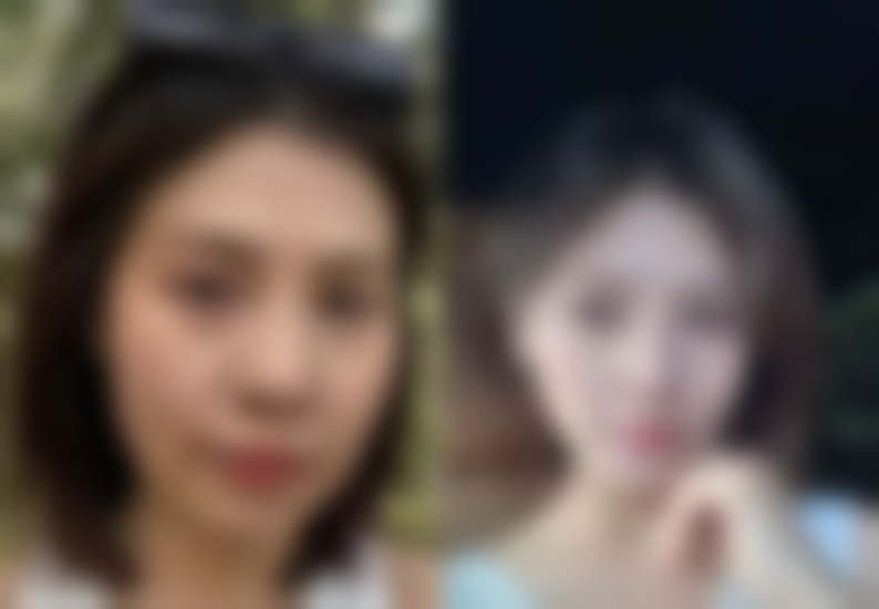 一、纳米双眼皮和割双眼皮的基本概念